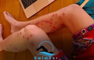 Can You Swim With Staph Infection