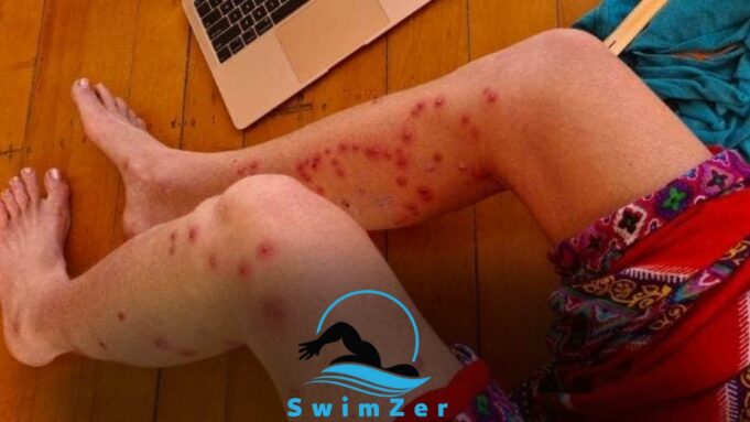 Can You Swim With Staph Infection